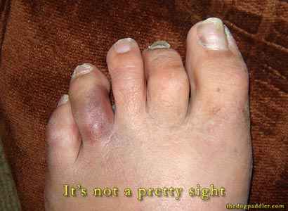 broken toe. (Broken Toe). IT#39;S NOT PRETTY